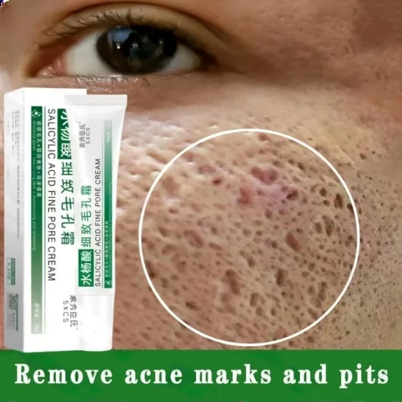 Azelaic Acid Cream - حمض الساليسيليك كريم إزالة المسام تقليص