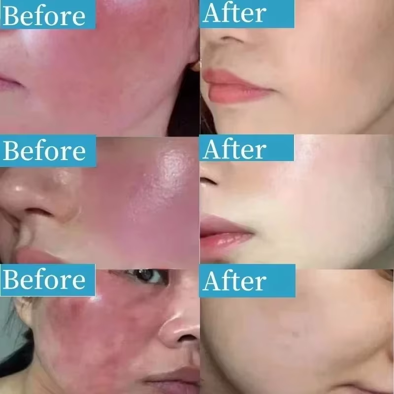كريم كوري لإصلاح احمرار الوجه، - مراجعة Coenzyme Q10 Cream وسعره