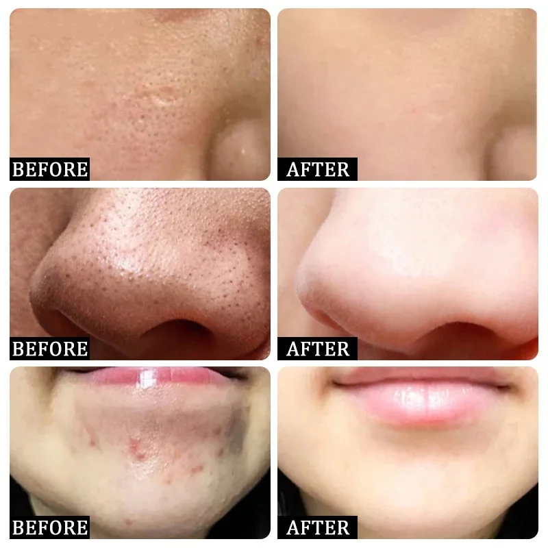 حمض الساليسيليك كريم إزالة الم - مراجعة Azelaic Acid Cream وسعره