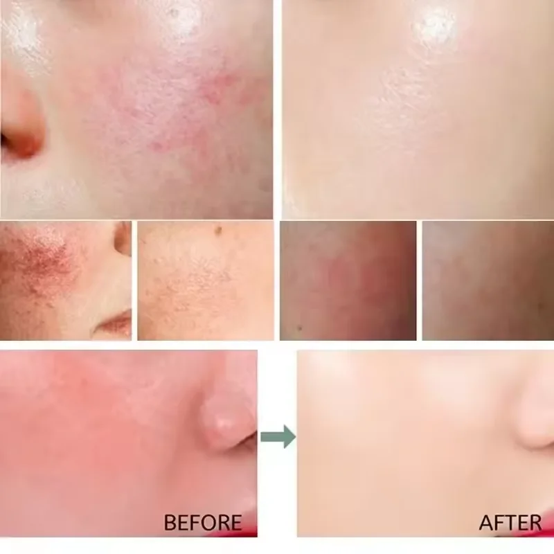 كريم إصلاح احمرار الوجه تحسين  - مراجعة Coenzyme Q10 Cream وسعره