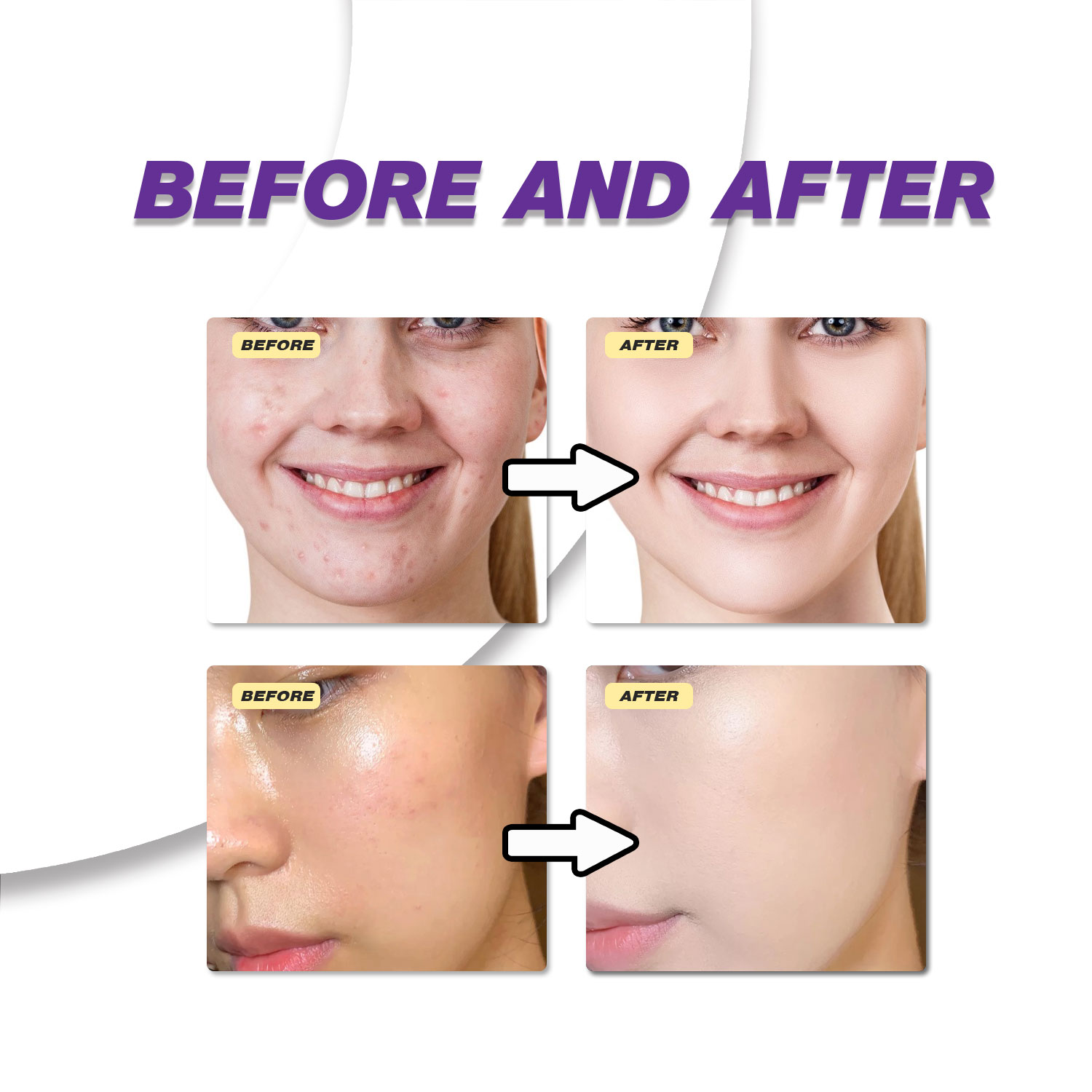 كريم حمض الأزيليك الخفيف لتحسي - مراجعة Azelaic Acid Cream وسعره