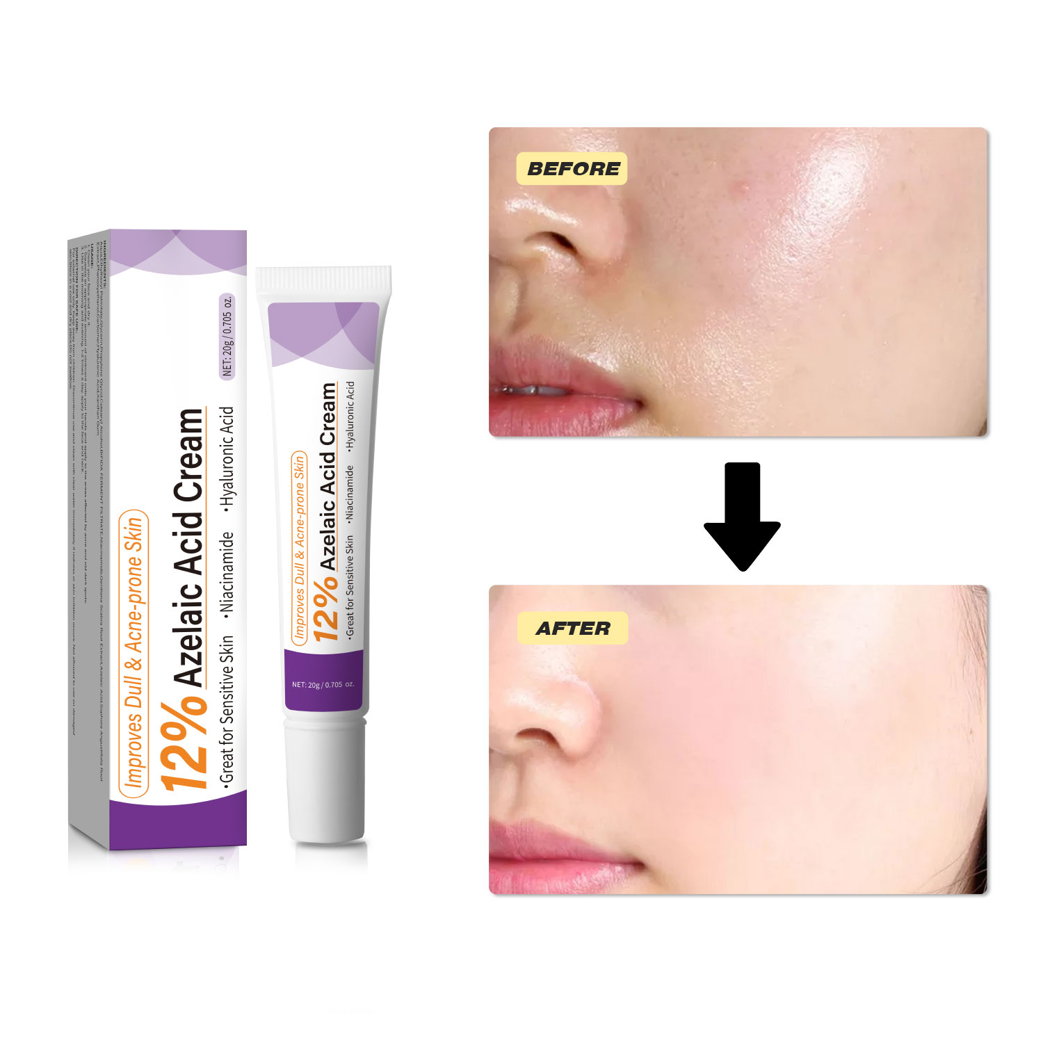 كريم حمض الأزيليك الخفيف لتحسي - مراجعة Azelaic Acid Cream وسعره